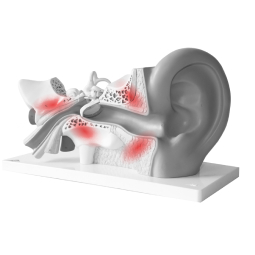Модель внутреннего уха с отмеченными зонами воспаления